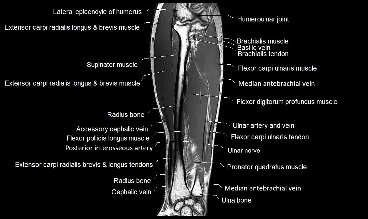 MRI 3T forearm coronal cross sectional anatomy image 16.webp